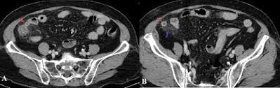 Hình ảnh CT viêm ruột thừa