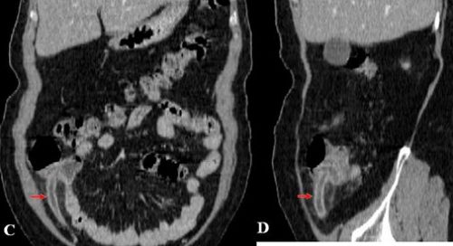 Hình ảnh CT viêm ruột thừa