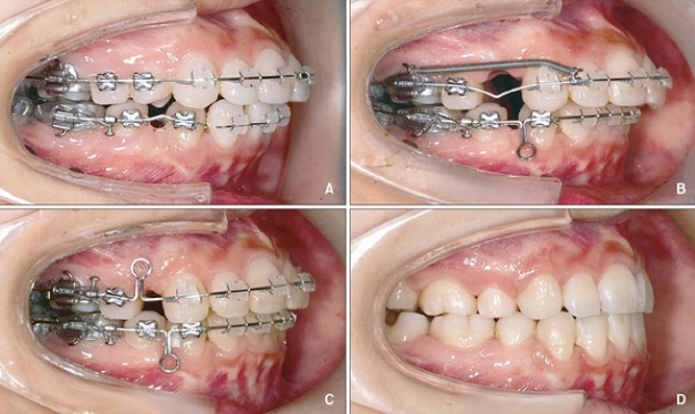 Hình ảnh niềng răng mắc cài qua các giai đoạn