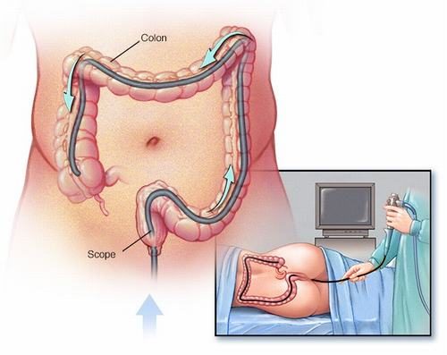 Hình ảnh nội soi đại tràng