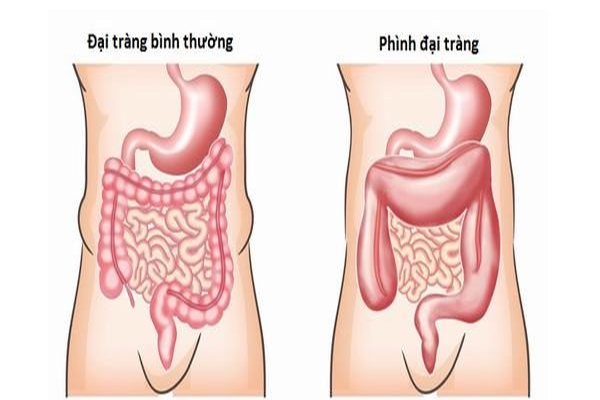 Hình ảnh phình đại tràng bẩm sinh