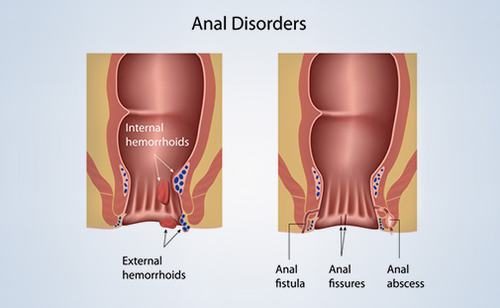 Hình ảnh polyp hậu môn