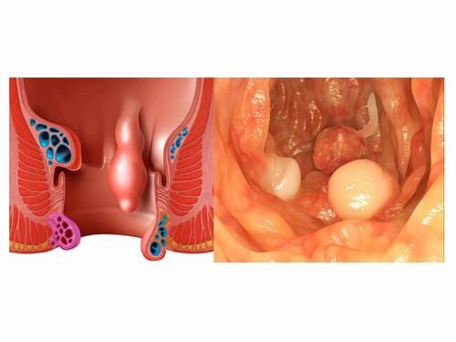 Hình ảnh polyp hậu môn