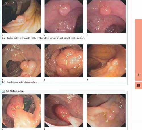 Hình ảnh polyp hậu môn