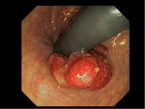 Hình ảnh polyp hậu môn