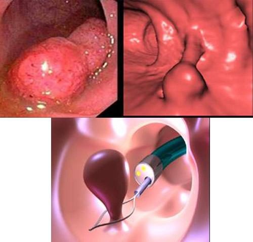 Hình ảnh polyp hậu môn