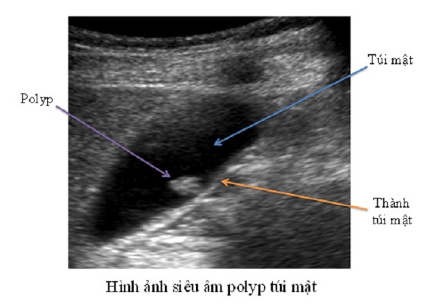 Hình ảnh polyp túi mật trên siêu âm như thế nào?