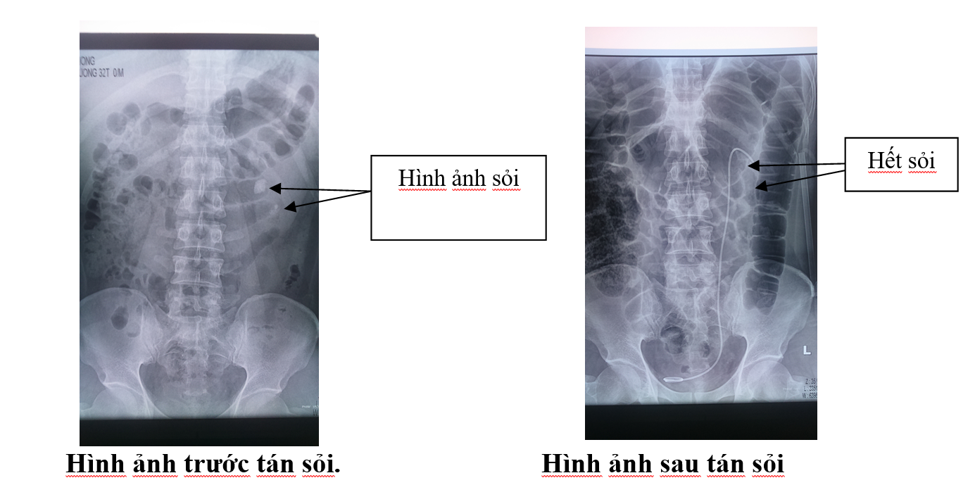 Hình ảnh sỏi niệu quản như thế nào?