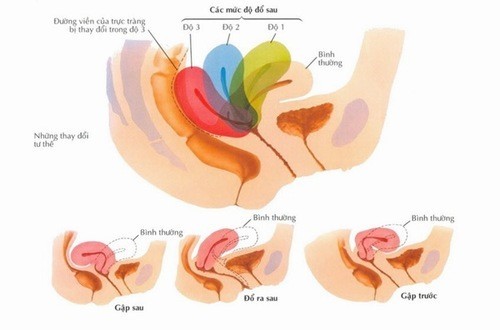 Hình ảnh tử cung bị sa biến chứng ảnh hưởng sức khỏe