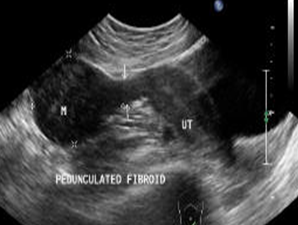 Hình ảnh u xơ tử cung trên siêu âm