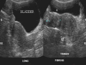 Hình ảnh u xơ tử cung trên siêu âm