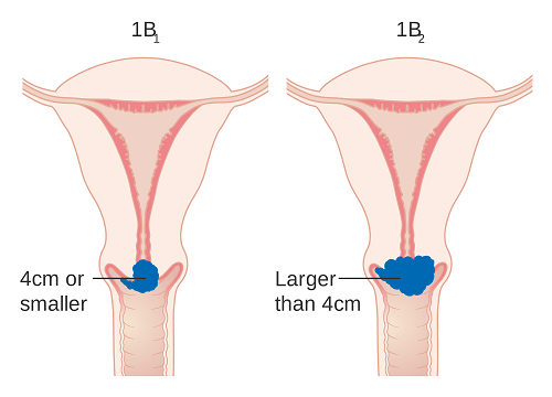 Hình ảnh ung thư cổ tử cung giai đoạn đầu