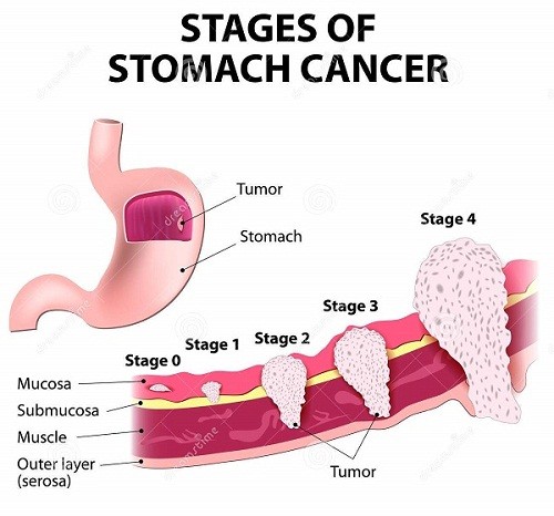 Hình ảnh ung thư dạ dày biến chứng nguy hiểm