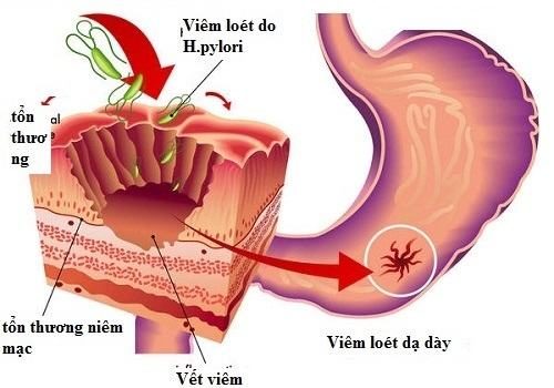 Hình ảnh ung thư dạ dày