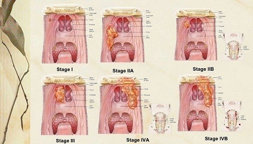 Hình ảnh ung thư vòm họng có mức độ nguy hiểm cao