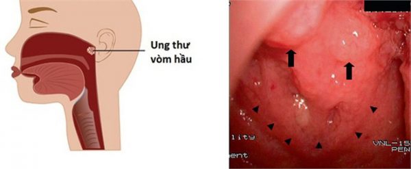 Hình ảnh ung thư vòm họng