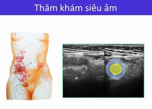 Hình ảnh viêm ruột thừa trên siêu âm