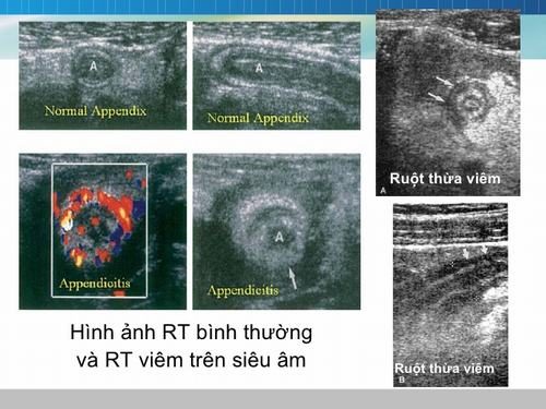 Hình ảnh viêm ruột thừa trên siêu âm