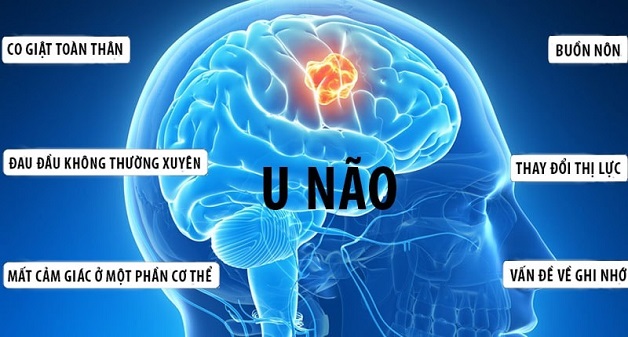 Ho đau nửa đầu là bệnh gì, có nguy hiểm không?