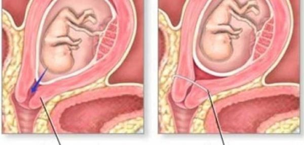 Hở eo tử cung là gì, có nguy hiểm không?