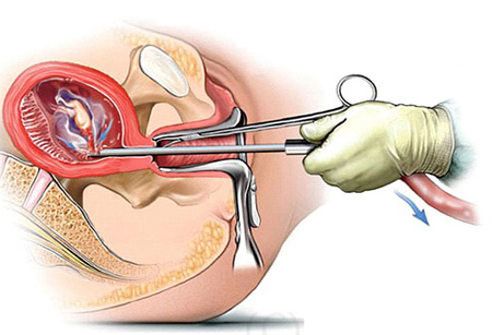 Hở eo tử cung: Nguyên nhân và cách xử trí