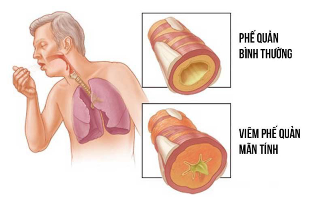 Ho khan ngứa cổ là biểu hiện của bệnh gì?