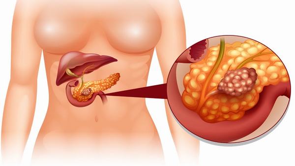 Hỗ trợ điều trị ung thư tuyến tụy giai đoạn IV