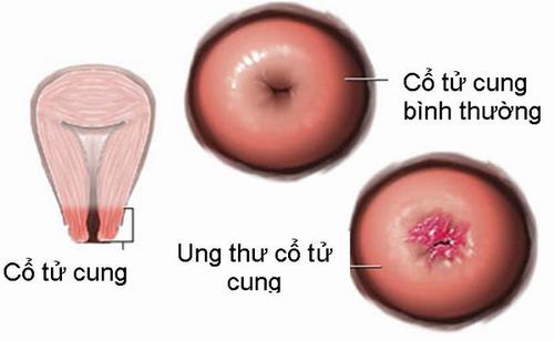 Hỗ trợ điều trị viêm cổ tử cung lộ tuyến