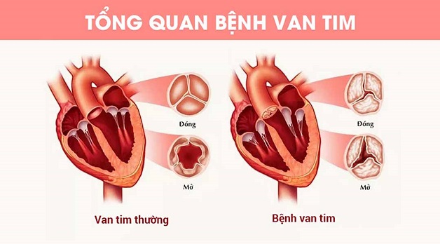 Hở và hẹp van tim: Nhận biết và điều trị thế nào?