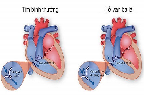 Hở van 3 lá là gì? Triệu chứng và Cách điều trị bệnh