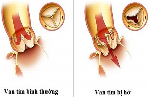 Hở van 3 lá nguy hiểm không? bệnh tim bẩm sinh