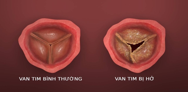 Hở van động mạch chủ 1/4 có nguy hiểm không?