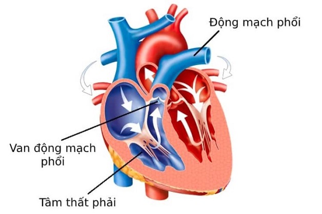 Hở van động mạch phổi nhẹ là gì? Cách chẩn đoán, điều trị