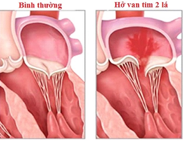 Hở van tim 2 lá 1/4: Không nguy hiểm nhưng chớ coi thường