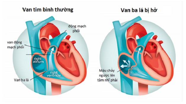 Hở van tim 3 lá 2/4: Triệu chứng, chẩn đoán và điều trị