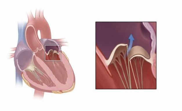 Hở van tim sống được bao lâu và cách kéo dài tuổi thọ