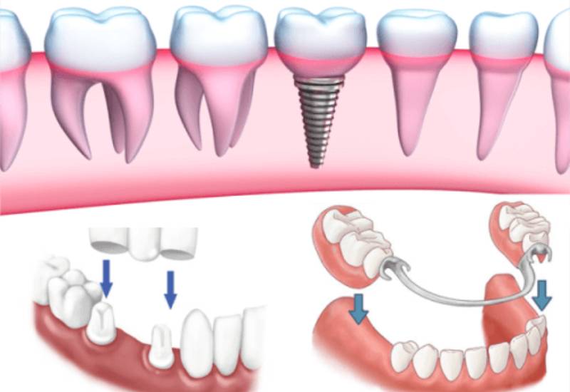 Hóa giải mối lo “trồng răng hàm có đau không”