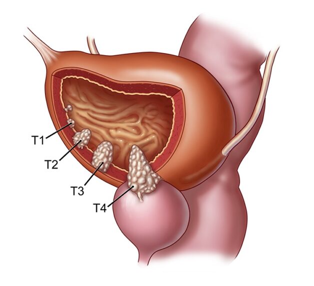 Hóa trị ung thư bàng quang – những điều cần biết