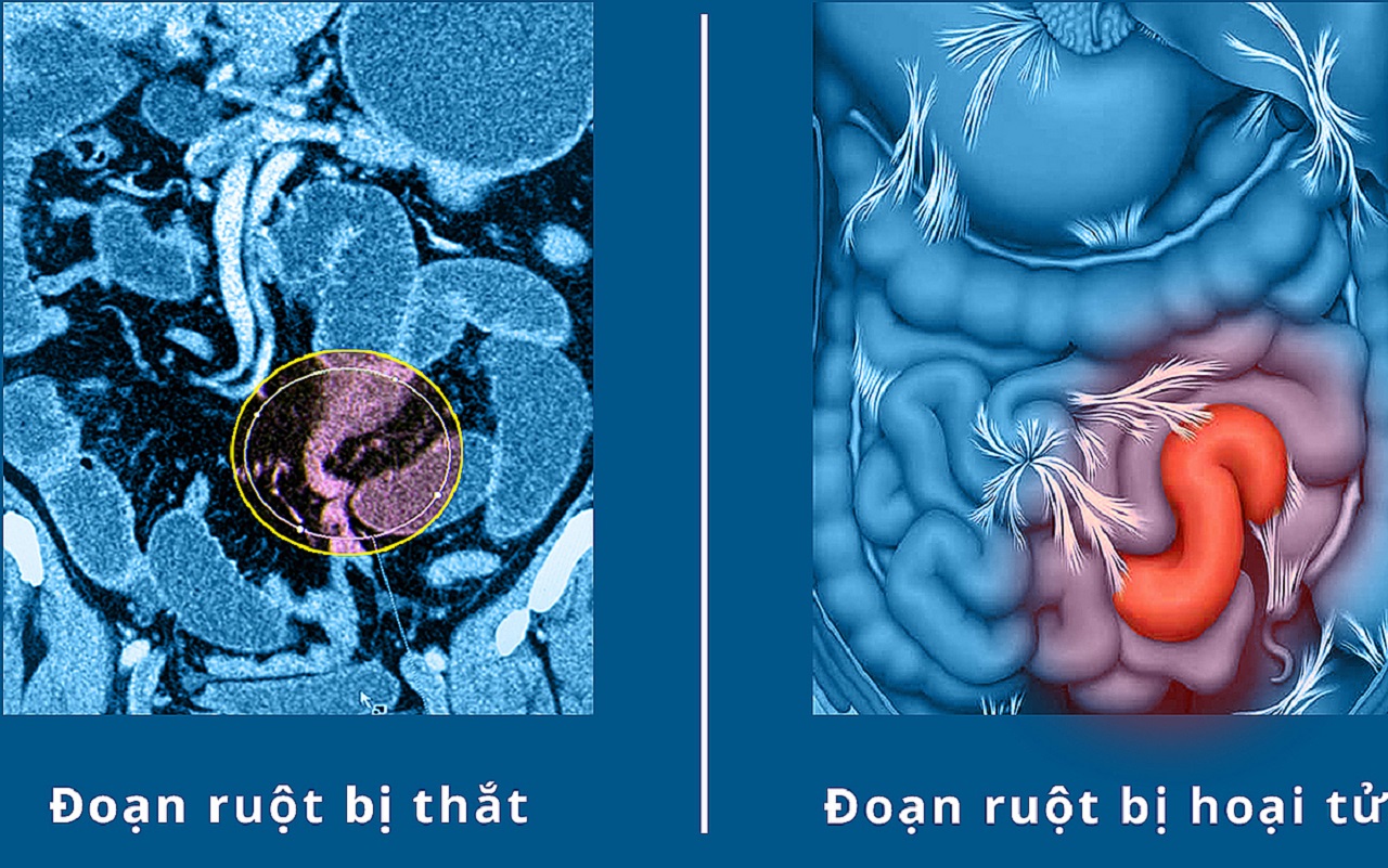 Hoại tử đường ruột và những điều cần biết