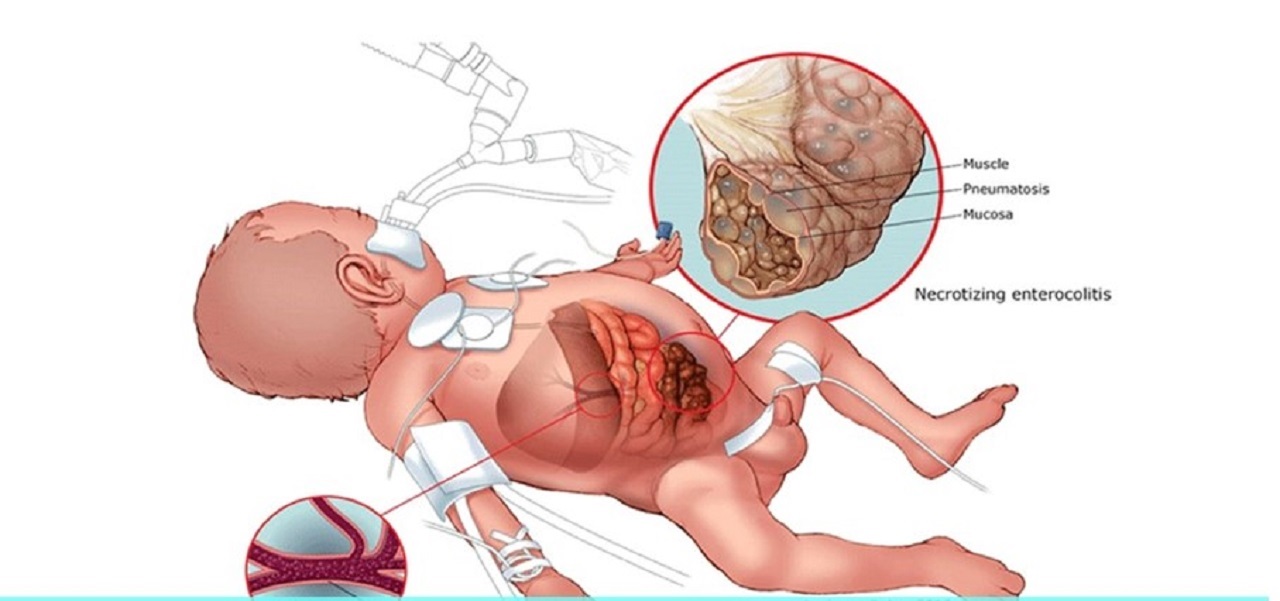 Hoại tử ruột ở trẻ sơ sinh: Dấu hiệu và điều trị