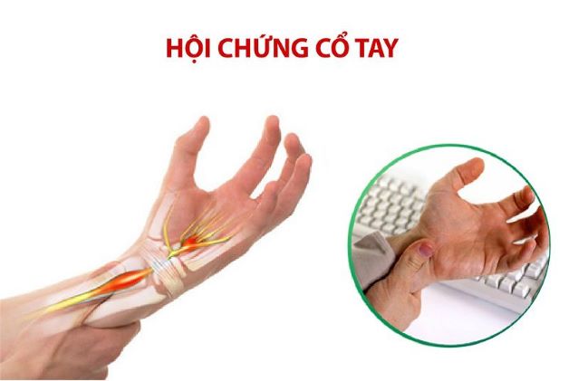 Hội chứng ống cổ tay: Nguyên nhân và cách điều trị