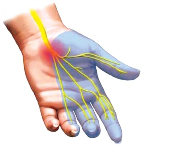 Hội chứng ống cổ tay  – nguyên nhân và cách điều trị