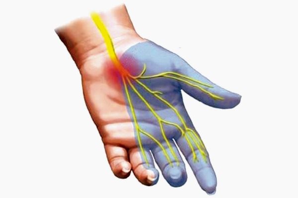 Hội chứng ổng cổ tay – Nguyên nhân và triệu chứng