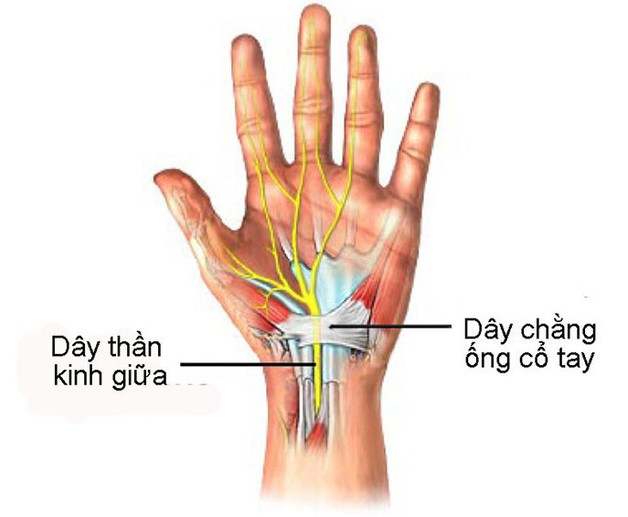 Hội chứng ống cổ tay và biểu hiện tê cổ tay, bàn tay cần nhận biết