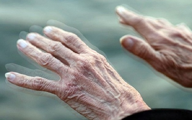 Hội chứng Parkinson có dấu hiệu gì?