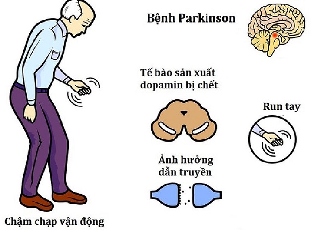 Hội chứng Parkinson – Nguyên nhân và triệu chứng