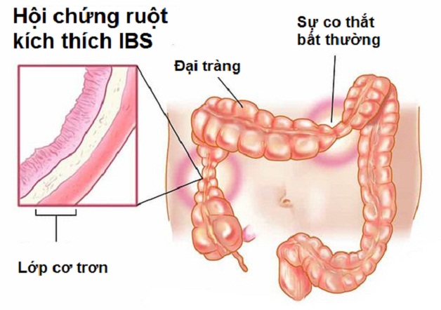 Hội chứng ruột bị kích thích là gì, điều trị như thế nào?