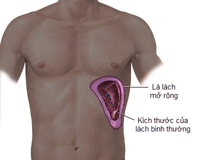 Hội chứng tăng áp lực tĩnh mạch cửa