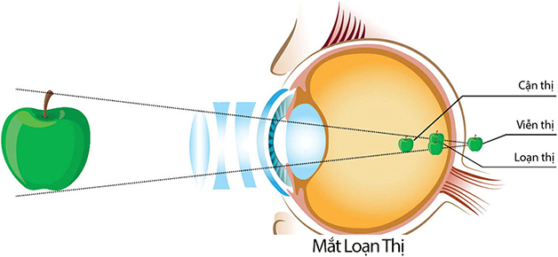 Hỏi đáp: Bị loạn thị có đeo lens được không