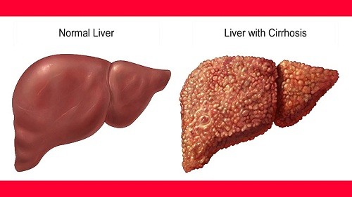 Hỏi đáp các bệnh lý về gan